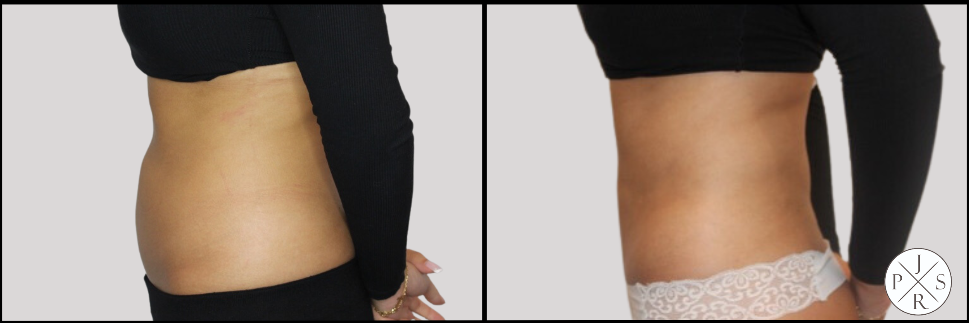 Liposuction Before & After Image